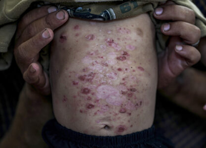 Israel Palestinians Skin Diseases