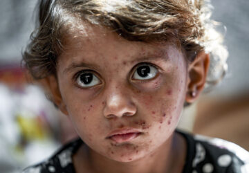 APTOPIX Israel Palestinians Skin Diseases